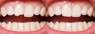 Picture of upper and lower teeth showing before and after having a dental bonding procedure.