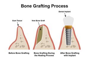 Illustration with 3 pictures showing a bone graft procedure