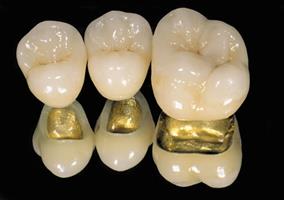 Picture of three gold-filled high noble pure porcelain dental crowns.
