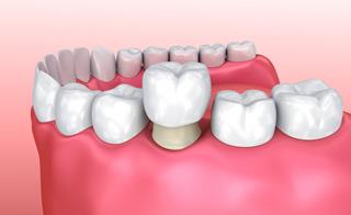Illustration of how a pure porcelain crown fits on a rehaped tooth