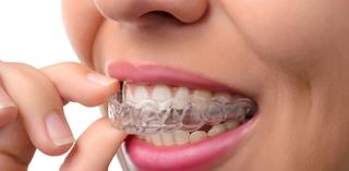 Picture of a smiling woman showing how Invisalign invisible braces are placed on the teeth